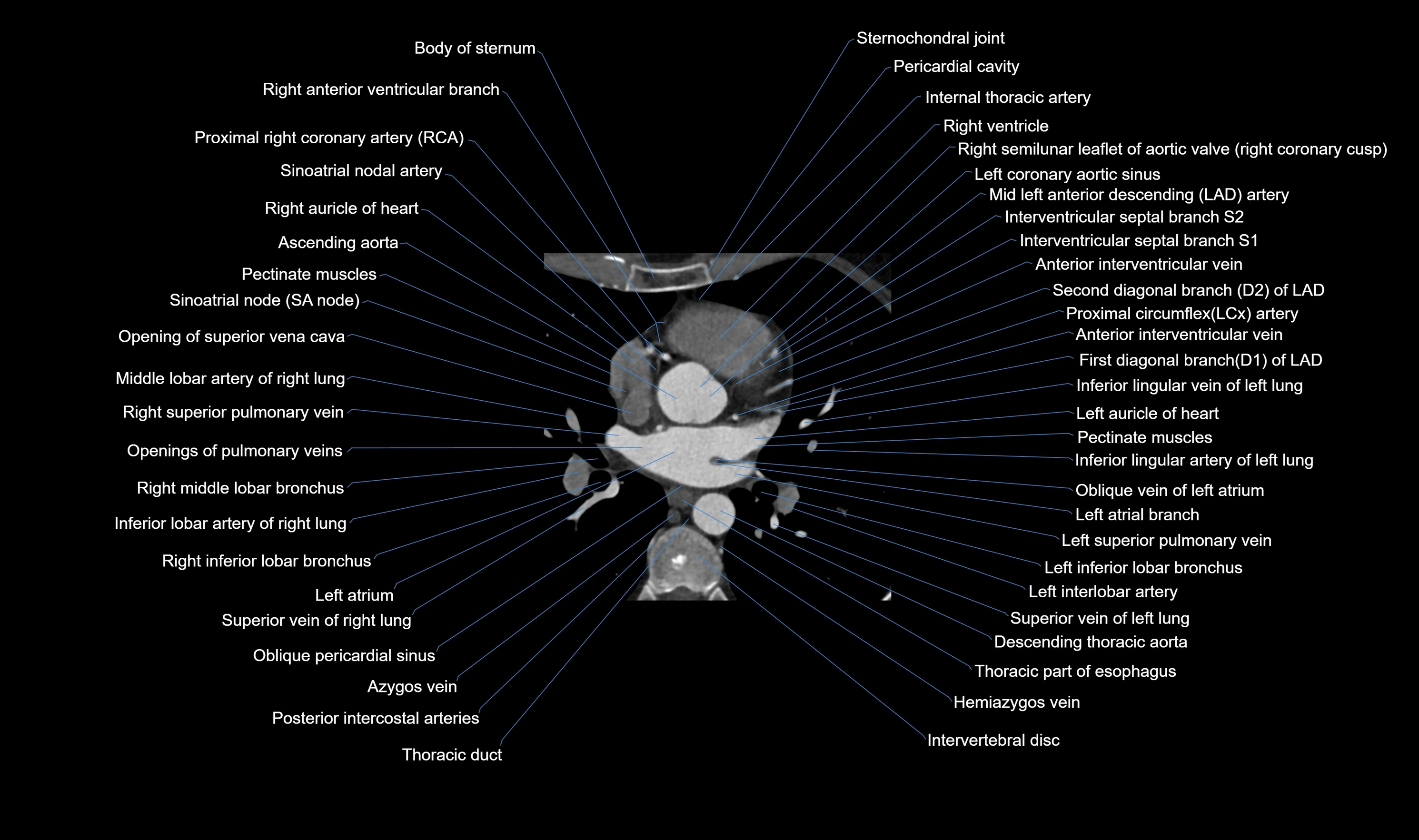 CT heart (coronary angiogram) axial view cross sectional anatomy labelled radiology image-00025.webp
